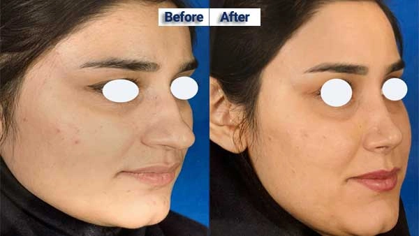 نمونه عمل های دکتر فریناز کلاهی از بهترین جراح بینی تبریز