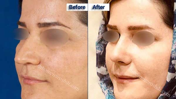 نمونه کار دکتر حمیرا رشدی تبریز بهترین جراح بینی تبریز