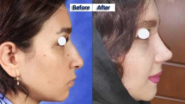 نمونه قبل و بعد جراحی بینی دکتر جواد توتونچی