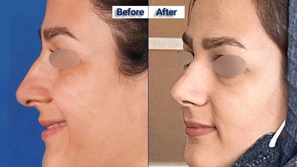 نمونه کار دکتر سحر زاهدی تبریز بهترین جراح بینی گوشتی در تبریز