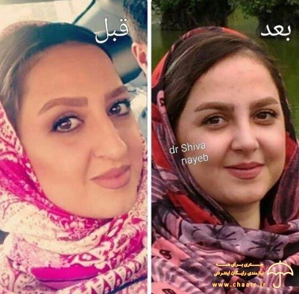 نمونه عمل بینی دکتر شیوا نایب تبریز بهترین جراح رینوپلاستی تبریز
